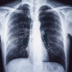 Chest-X-Ray