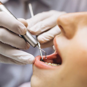 Dental Extraction