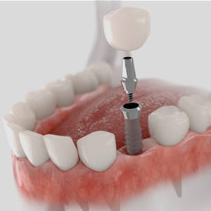 Dental Implant