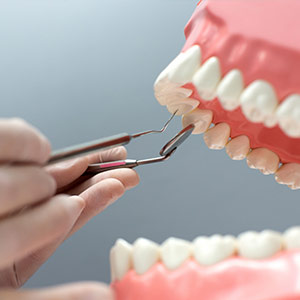 Dental-Scaling