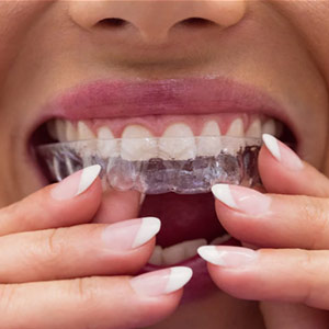 Invisible Braces Treatment