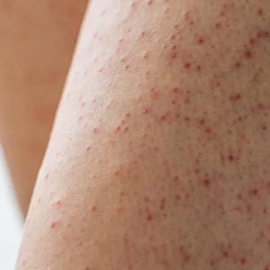 Keratosis Pilaris