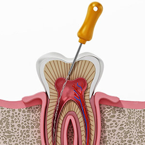 Root Canal