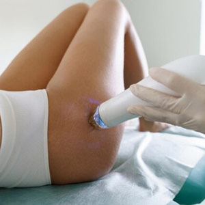 Stretch Mark Removal