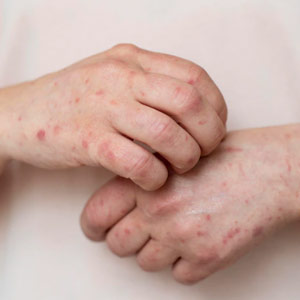Urticaria
